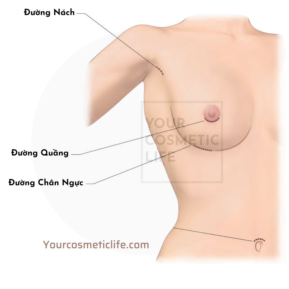 Đường mổ nâng ngực thẩm mỹ: Đường nách, Đường quầng, Đường chân ngực