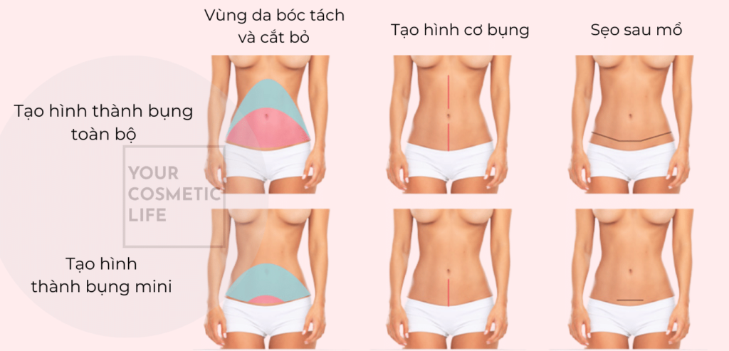 Tạo hình thành bụng toàn bộ và mini khác nhau như thế nào