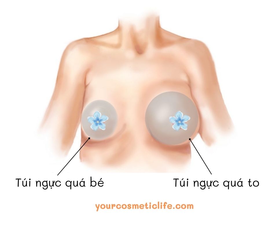 Chọn size túi ngực phù hợp
