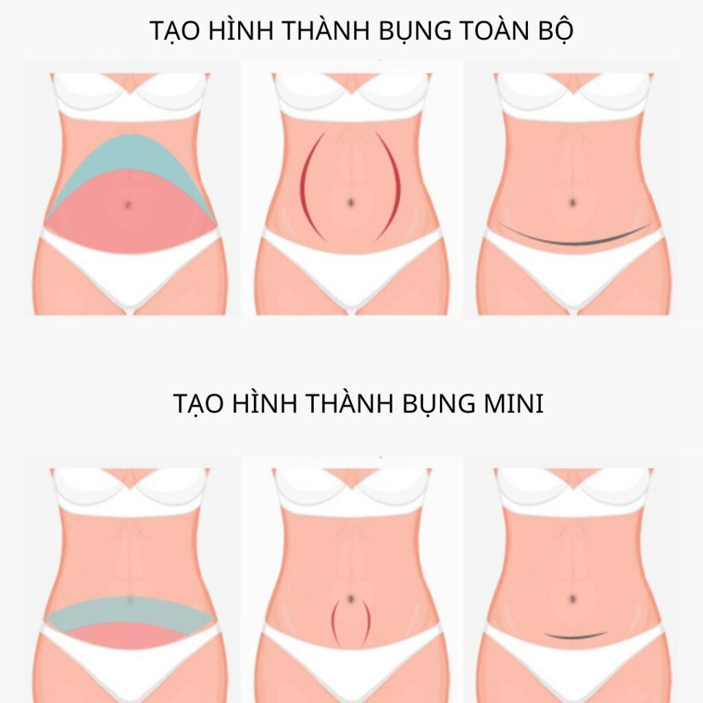 Tạo hình thành bụng mini và tạo hình thành bụng toàn bộ